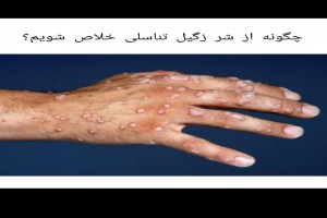 رفع زگیل تناسلی در خانه