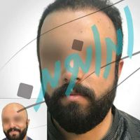 کلینیک کاشت مو