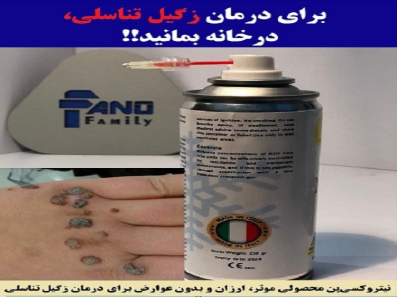 درمان زگیل تناسلی در خانه(اسپری کرایوتراپی)0