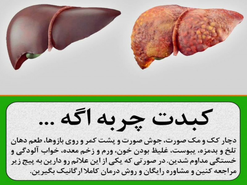 درمان کبد چرب در خانه0