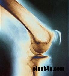 سرمایه گذاری در طرح اختراع نوعی ترکیب دارویی جهت درمان ضایعات استخوانی -فروش طرح داروی درمان ضایعات استخوانی 0