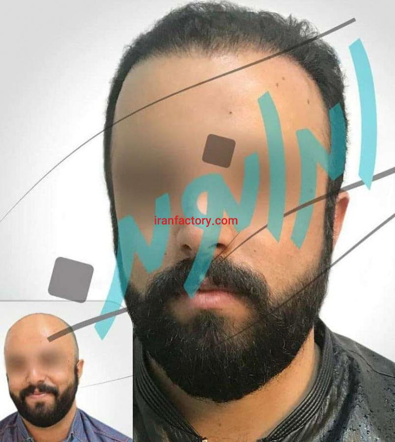 کلینیک کاشت مو0