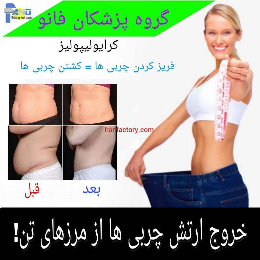 خدمات لاغری کرایولیپولیز0