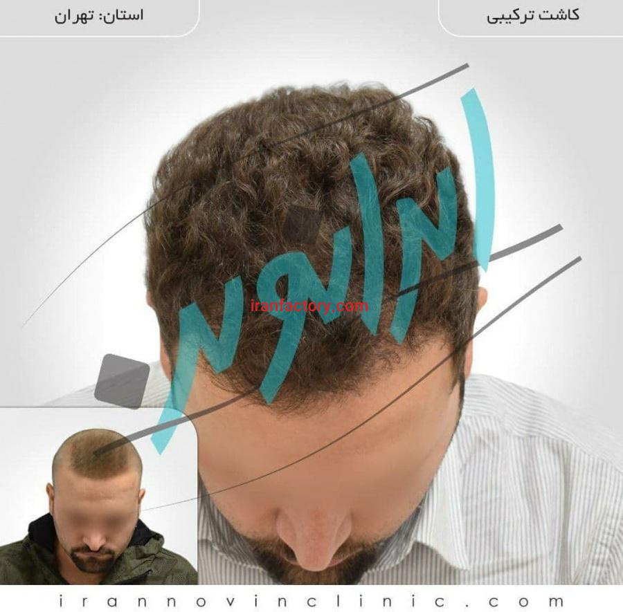 کلینیک کاشت مو1