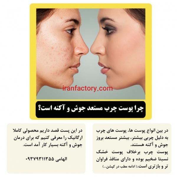 درمان خانگی جوش و آکنه با اسکراب مدیترانه ای